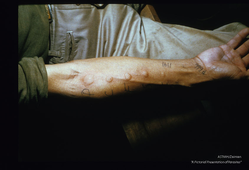 Intradermal skin tests for multiple parasites. The top injection is positive for Paragonimus. The other tests were for Clonorchis, Fasciola, Schistosoma, and a control.