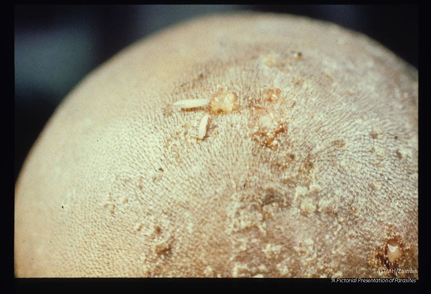 Myiasis. Immature larvae on boy's head. These were obtained after "Albahaca infusion" (Ocimun basilicum) treatment.