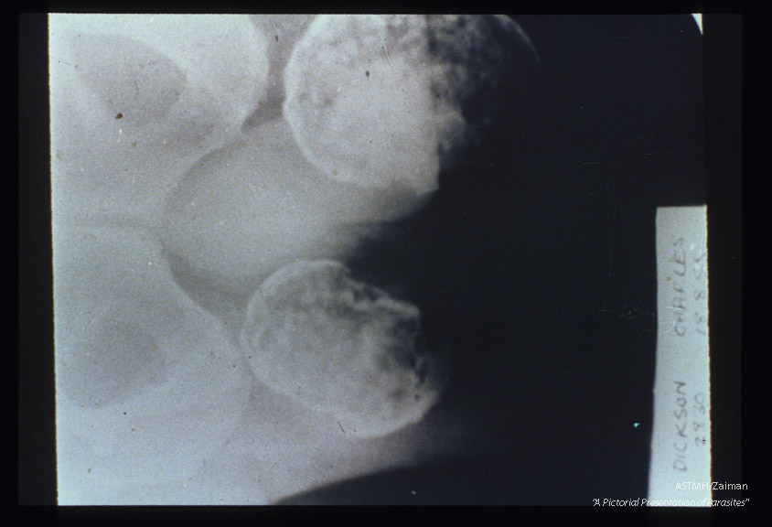 Calcification in testes demonstrated by x-ray.