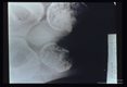 Calcification in testes demonstrated by x-ray.