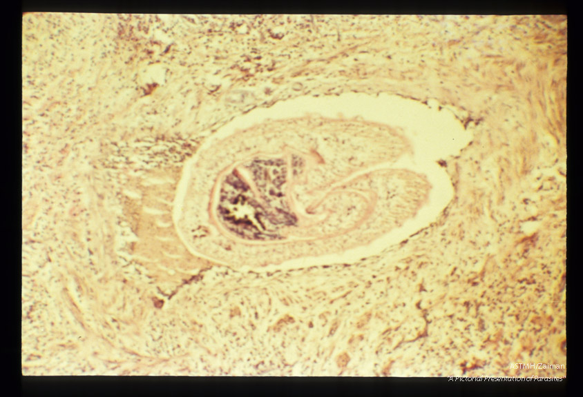 Adults and ova in human testicle.