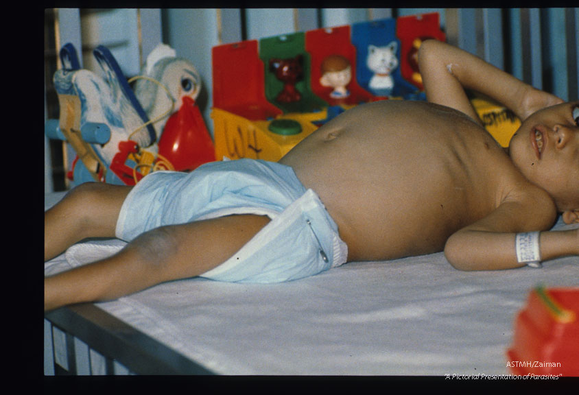 Four year old Puerto Rican patient with multiple parasites including Strongyloides stercoralis, hookworm, Ascaris lumbricoides and Trichuris trichiura. He was small of stature (equivalent to a one and three quarter year old) and his weight was that of a two and a half year old.
