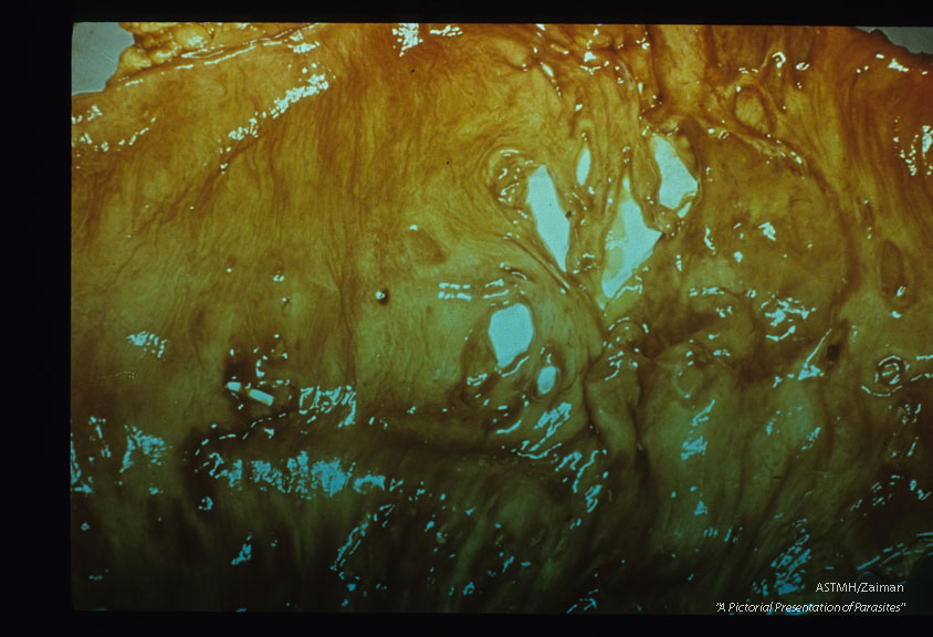 Bowel perforation. White areas are paper showing through holes.