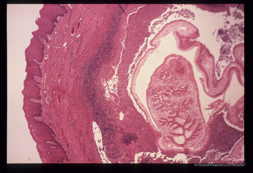 Low and high power views of cysticercus removed from buccal mucosa of patient.