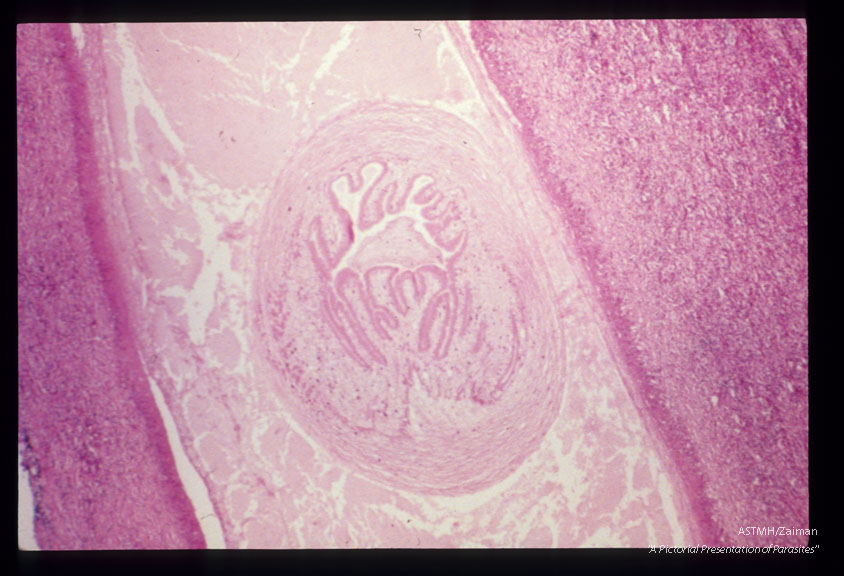 Cysticercus compressed by forehead tissues.