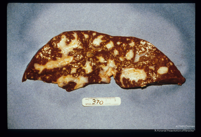 Various magnifications of advanced pipe stem fibrosis in an experimentally infected chimpanzee.