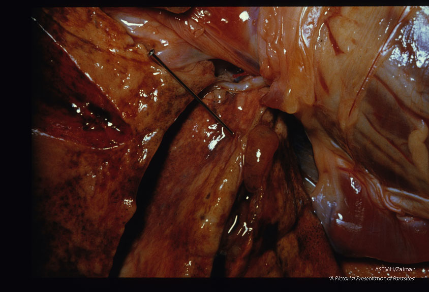 An adult Paragonimus is free on the surface of this lung.