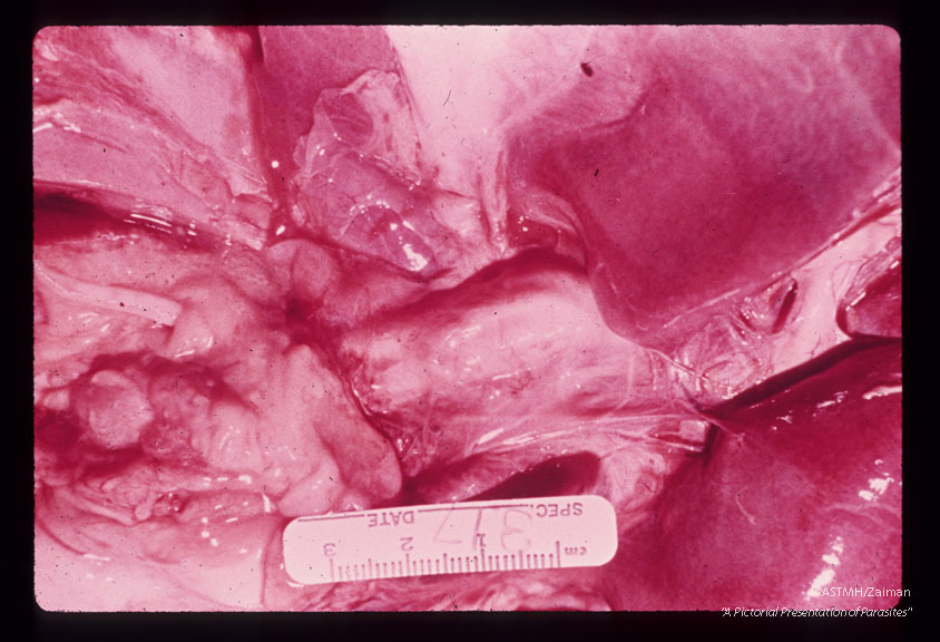 Autopsy specimen showing adult in ampulla of Vater.