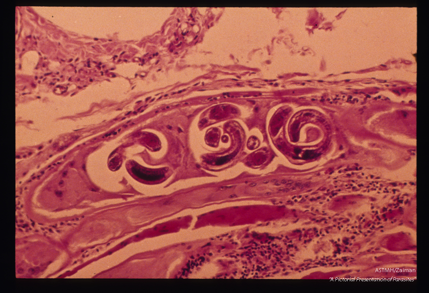 Three larvae in a single cyst (same case).