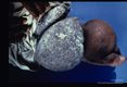 Elephantiasis of foot and heavily hyper- keratotic ankle lobules on left leg of a fifty-five year old male. Elephantiasis began twenty years earlier and the left leg is now enormously enlarged.