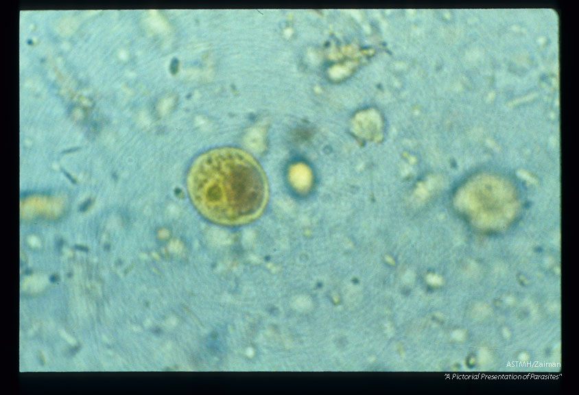 Iodine stained cyst in stool.