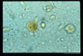 Iodine stained cyst in stool.