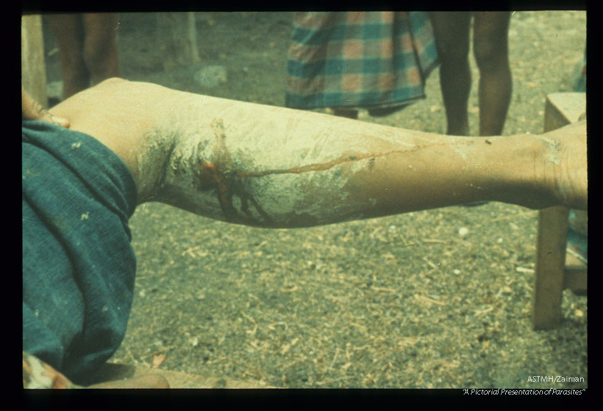 Draining abscess. White coloration due to application of native medication.