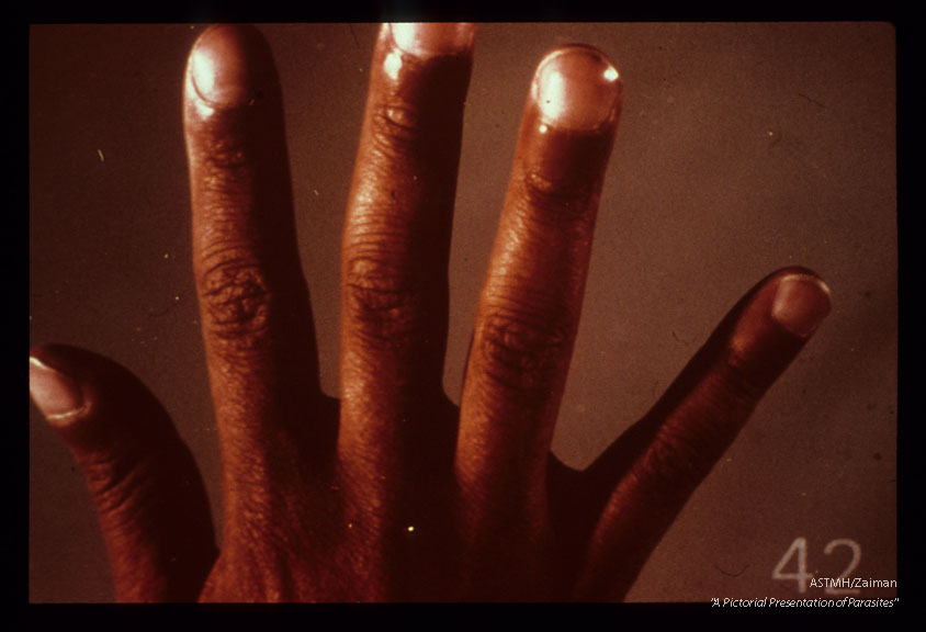 This young patient shows watch glass shaped nails characteristic of chronic oxygen deprivation which in mis case was due to pulmonary schistosomiasis.