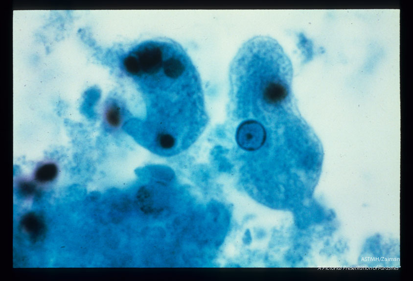 Mobile trophozoite showing nucleus and a single red blood cell.