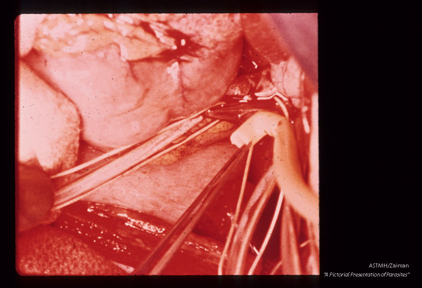 Mobilization of hepatic vein and insertion of tubing leading to bypass filter.