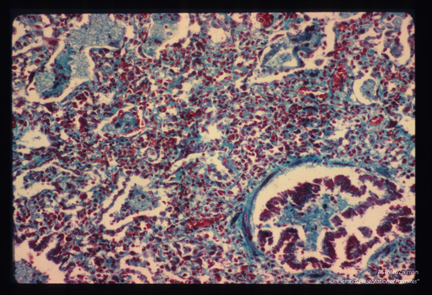 Pneumonia. Low power view of infected lung stained by Wheatly modification of trichrome stain for stools demonstrating alveoli and a small bronchiole invaded by parasites. "Honeycomb" material is present.