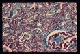 Pneumonia. Low power view of infected lung stained by Wheatly modification of trichrome stain for stools demonstrating alveoli and a small bronchiole invaded by parasites. 