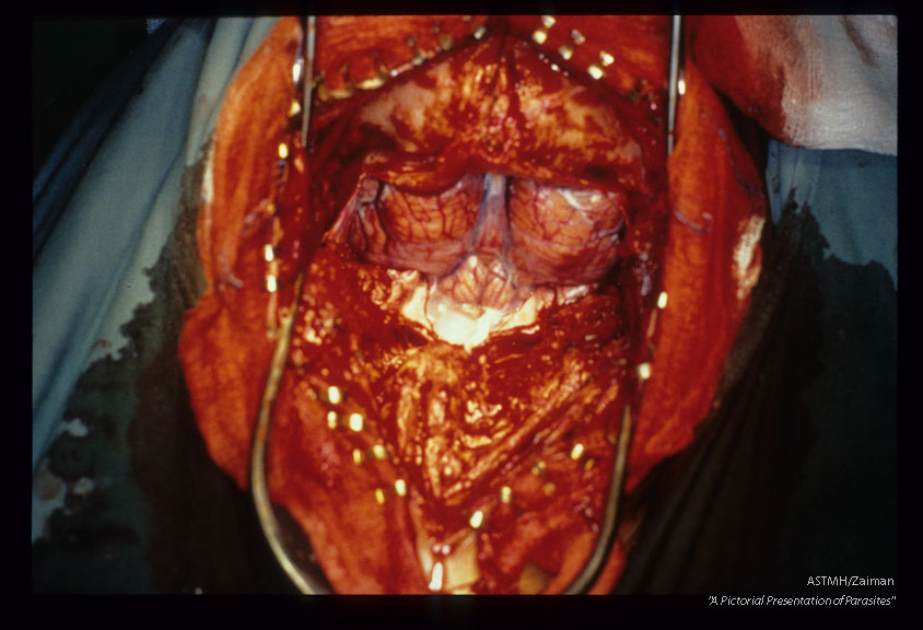 Cysticerci "bubble up" from cisterna magna during surgery.