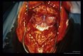 Cysticerci 