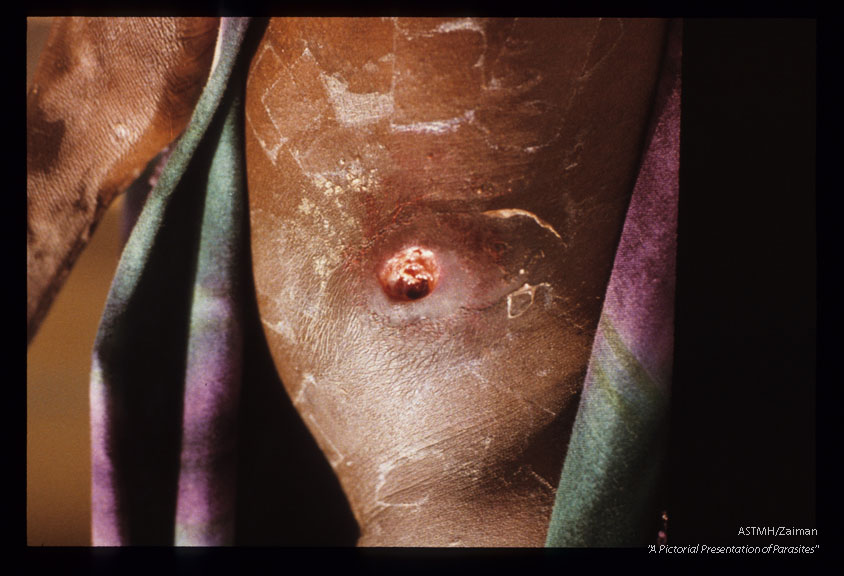 Rare case of a perforating nodule at the iliac crest of an adult man. Female Onchocerca volvulus are in the wound. From St. Paul River in Liberia.