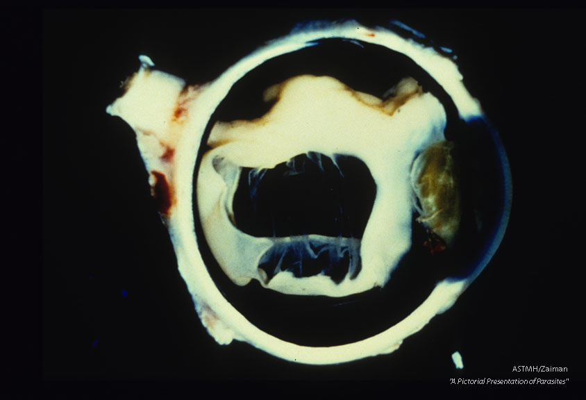 Retinal detachment in a human eye due to T. canis larvae.