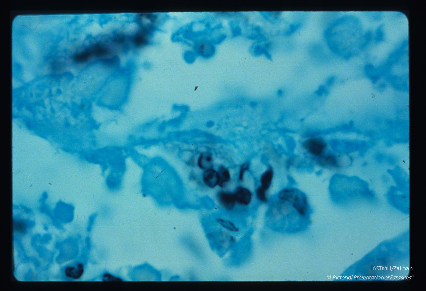 Pneumonia. High powered view of infected lung designed to illustrate dark staining nucleus and parasite wall by silver methenamine technique.