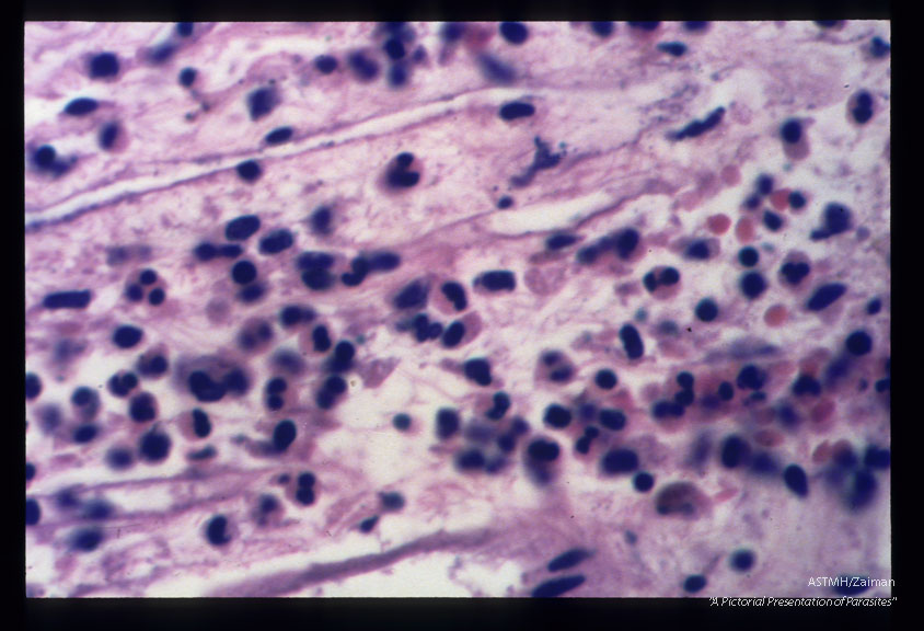 Chronically inflamed choroid plexus.