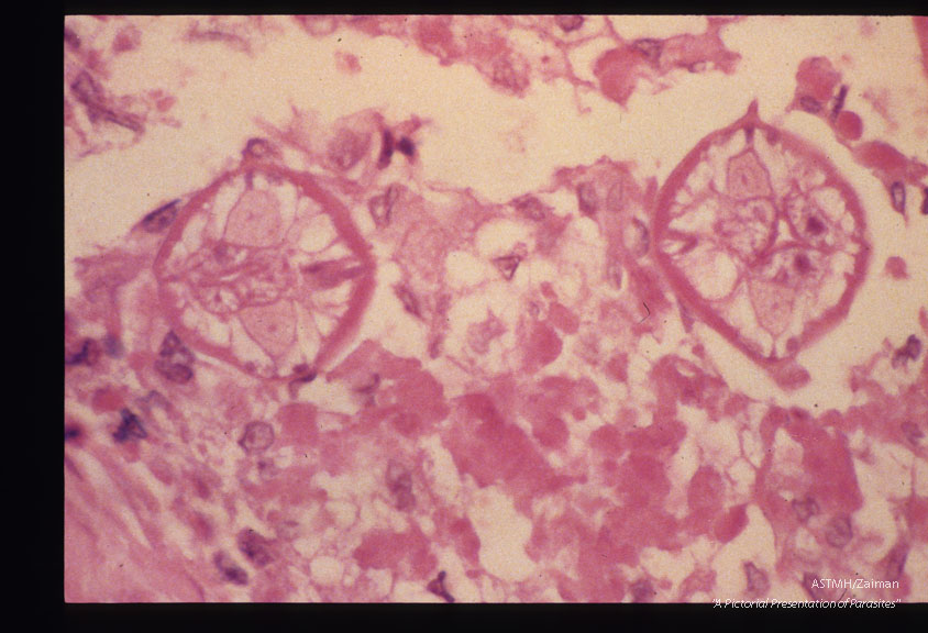 Same case. Larva in pulmonary granuloma.