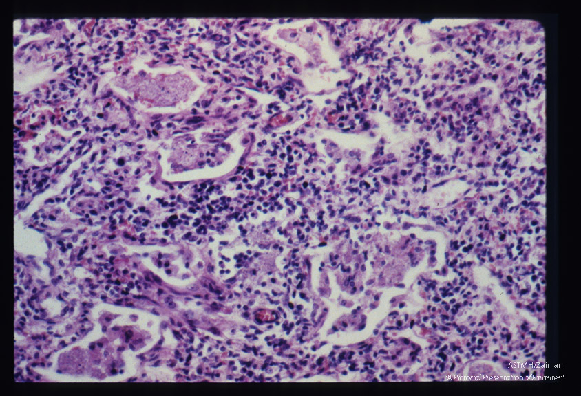 Pneumonia. Slightly larger magnification shows thickened alveolar walls invaded by large numbers of plasma cells and lymphocytes. The alveolar spaces are filled with honeycomb material. There is no neutrophilic leucocytic infiltration nor is a fibrinous deposit present.