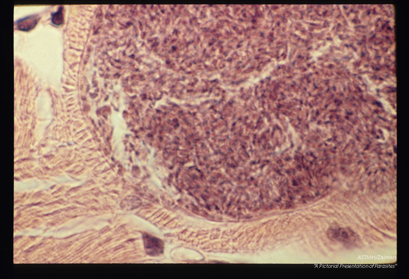 Cyst in human muscle. Biopsy specimen.