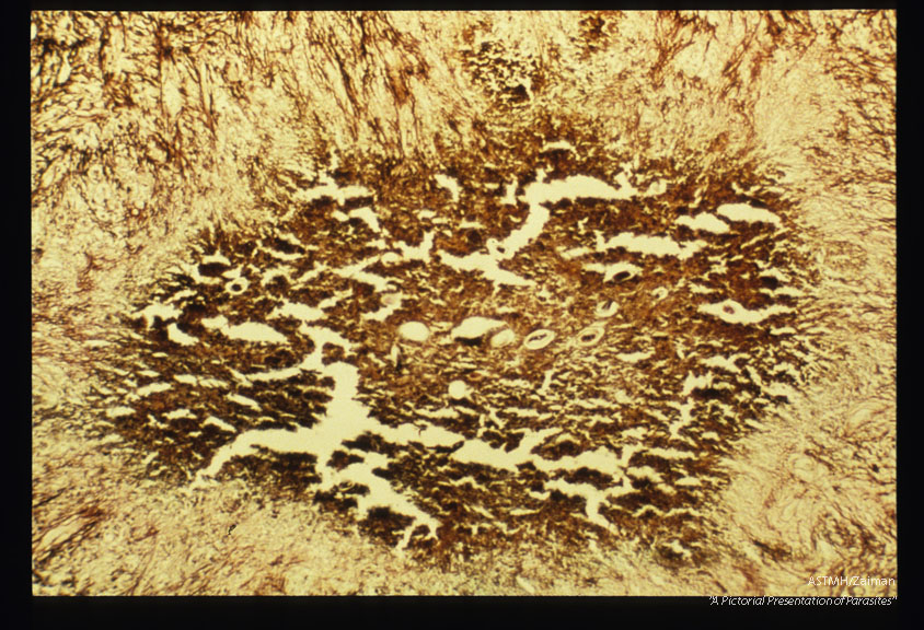 Low and high power views of eggs in necrotic granulomatous pelvic lesions. The patient was a young female who suffered chronic dysrnenorrhea, dyspareunia and lower abdominal discomfort. Silver methenamine stain.