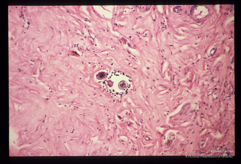 Fallopian tube with granulomata containing parasite eggs.