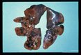 Massive infection showing numerous pulmonary cysts containing adult Paragonimus in a cat exposed to 200 parasites.