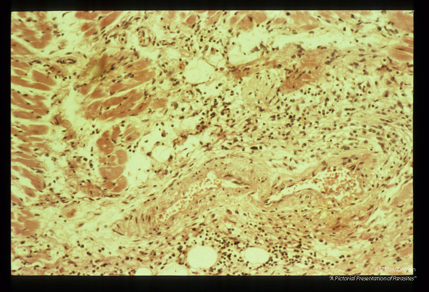 Myocarditis with petivasscular mononuclear infiltrate.