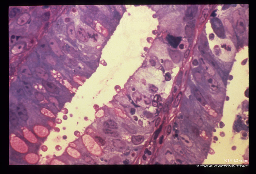 Rectal biopsy, epoxy thick section.