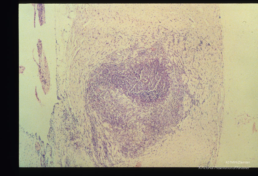 Large eosinophile-rich granuloma occupying almost the entire width of the right ventricular free wall. Naturally infected cat. HE, x 40.