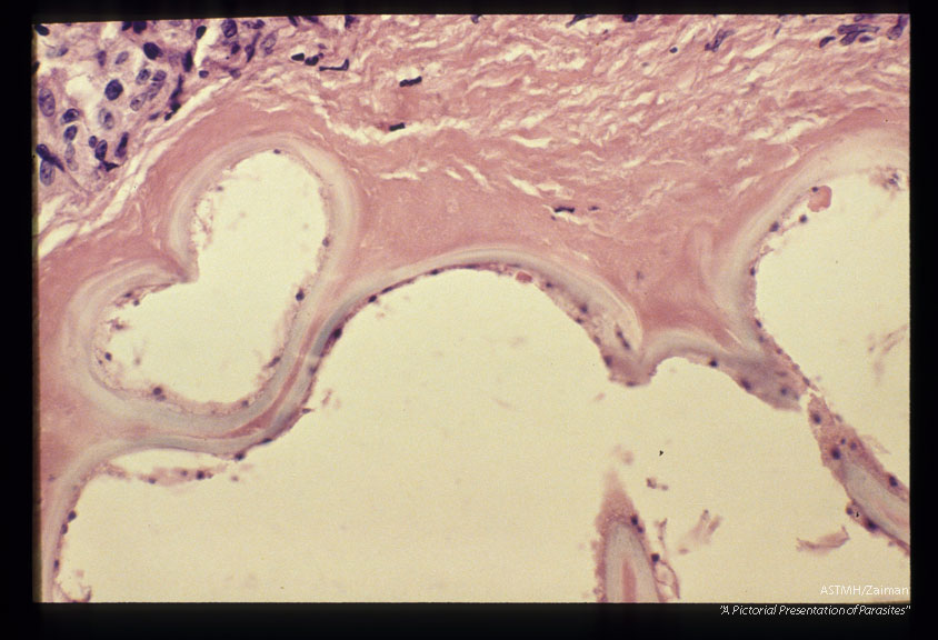 Gross and microscopic photos of human liver from Minnesota where about one half of the red foxes are infected.