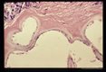 Gross and microscopic photos of human liver from Minnesota where about one half of the red foxes are infected.