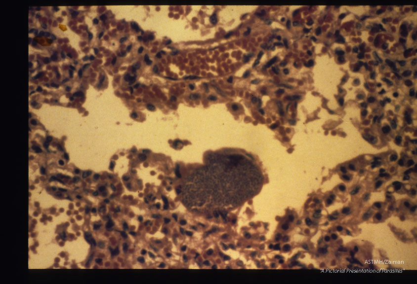 A large parasitized cell protrudes into an alveolus of this patient suffering from congenitally transmitted Chagas' disease.