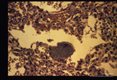 A large parasitized cell protrudes into an alveolus of this patient suffering from congenitally transmitted Chagas' disease.