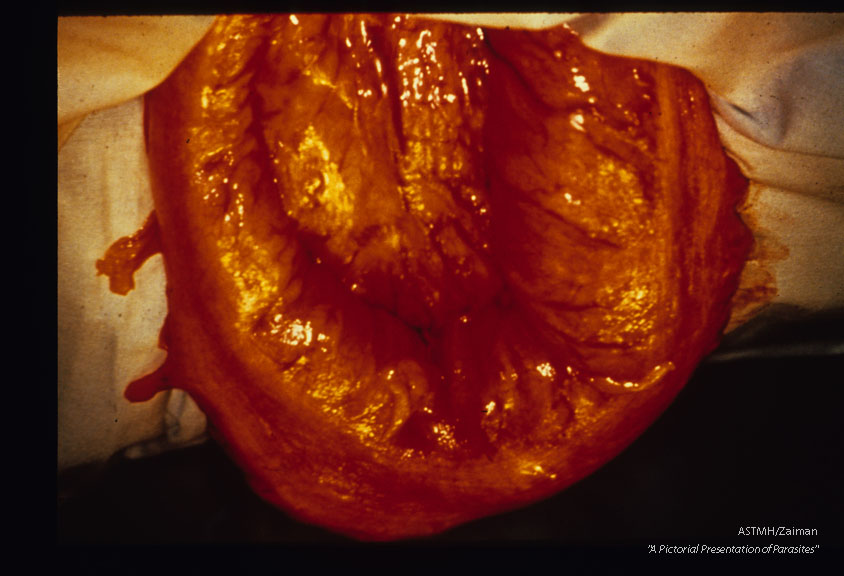 Megacolon at autopsy.