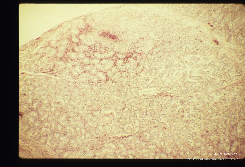 Five year old male. Testicle showing multiple eosinophilic infiltrates at various magnifications.