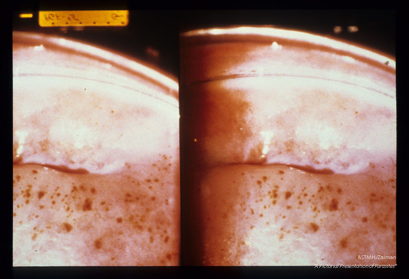 Uterine cervix showing multiple punctate red lesions characteristic of the strawberry cervix.