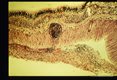 Occular larva migrans. Lymphatic perivascular cuff in human retina.