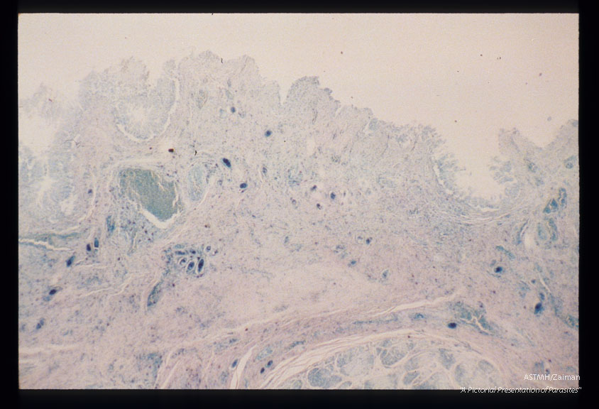 Bladder biopsies from an Egyptian.