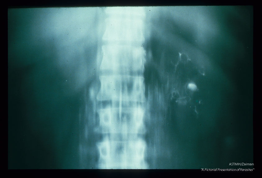 The next four slides represent a remarkable radiographic demonstration of the pathological physiology involved in production of chyluria. Bilateral lymphangiograms were obtained by injecting contrast into inter-digital lymphatics. X-rays made subsequently reveal (white) dilated tortuous lymphatic channels. Flow in the lymphatics is obstructed high in the abdomen and in the chest Backflow occurs outlining the pericalyceal lymphatics and the buttercup-like renal calyces. Subsequently, the urinary bladder Fills with contrast and becomes white. In short, obstruction to lymphatic flow causes reverse flow to the kidneys and subsequently to the bladder. Consult your local radiologist for help. He will enjoy these slides.