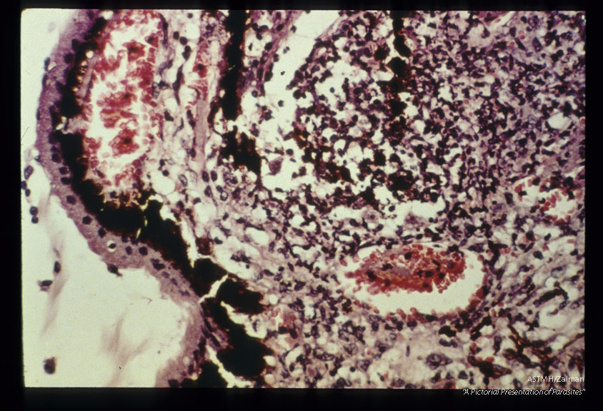 Fatal case with uveitis and meningoencephalitis. Uveitis showing reaction.