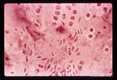 First-generation merozoites and second-generation trophozoites. Note the absence of refractile globules. H & E stain. (72 hr).