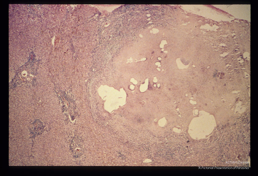 Gross and microscopic photos of human liver from Minnesota where about one half of the red foxes are infected.